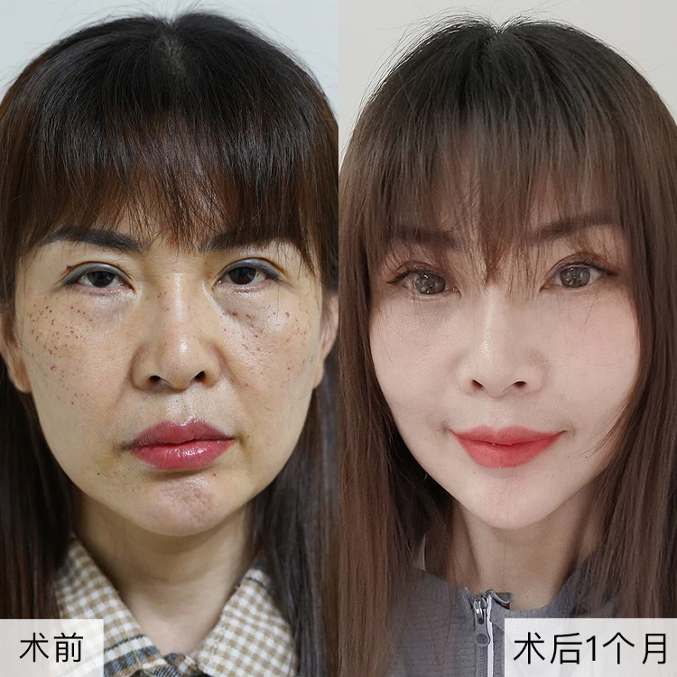 Skruosto pakėlimo operacija